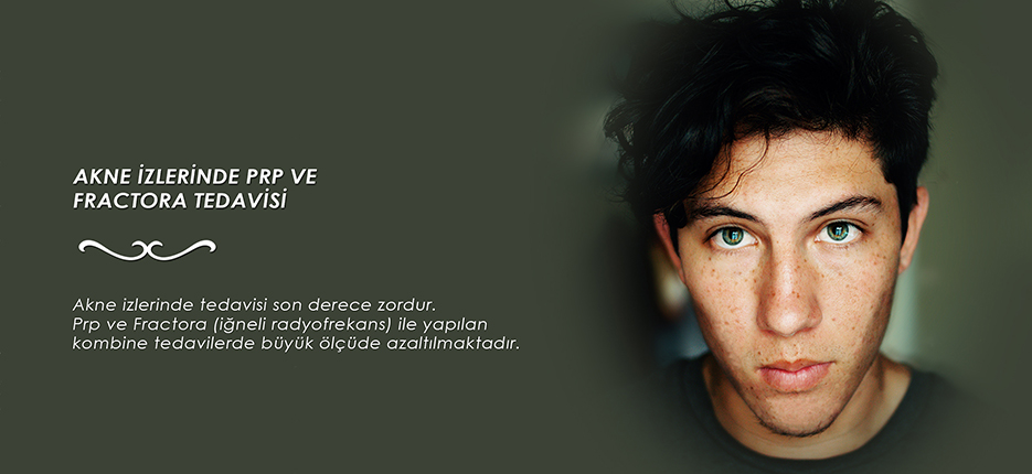 akne izleri prp fraktora tedavisi