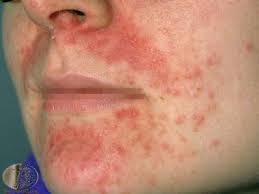 perioral dermatit