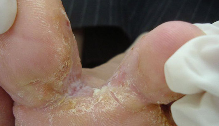 tinea pedis