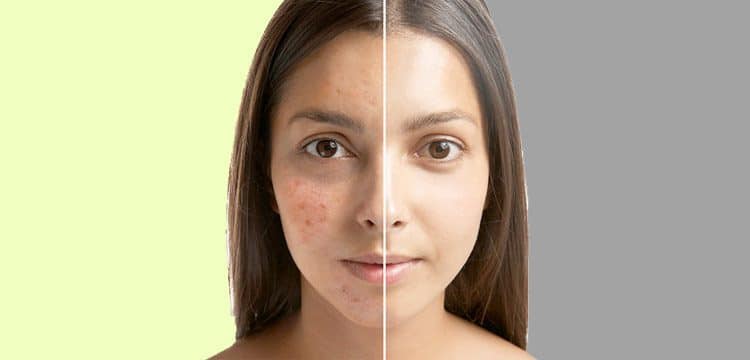 acne vulgaris tedavisi ankara dermatoloji